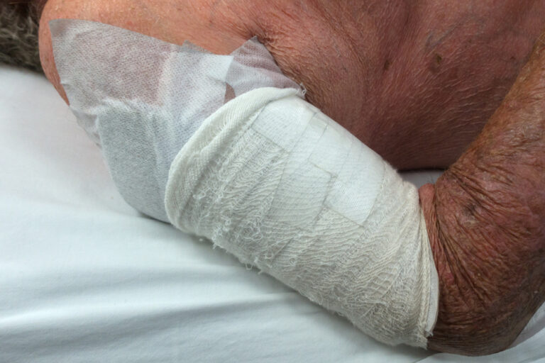 What is a Degloving Injury and Why Do I Need a Lawyer? San Diego Firm
